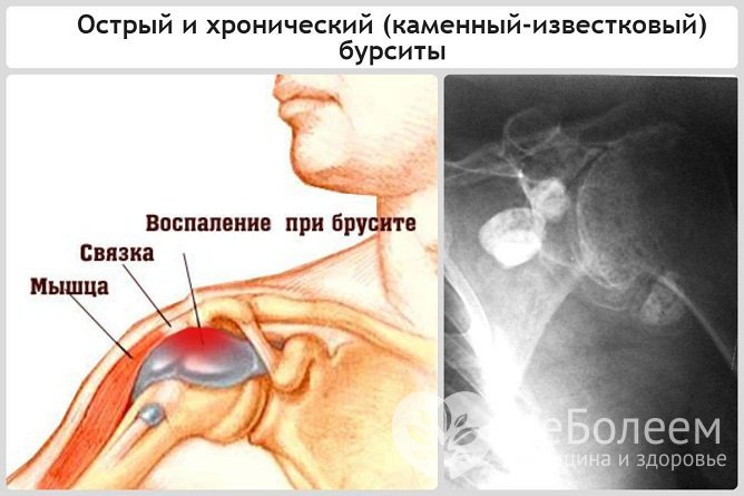 Выделяют острый, подострый, хронический бурситы плечевого сустава