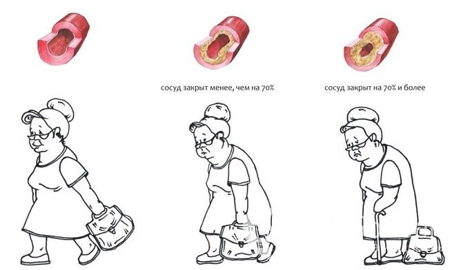 Развитие церебрального атеросклероза