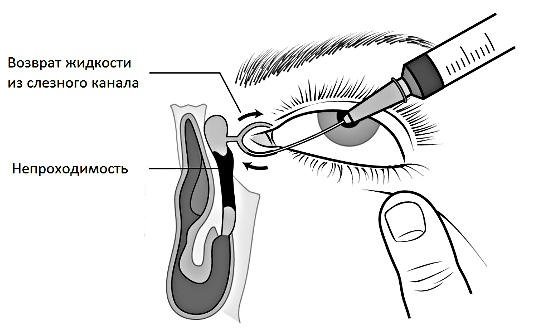 Зондирование слезных протоков при дакриоцистите у новорожденных 