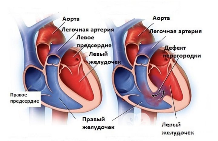 Признаки дефекта межпредсердной перегородки