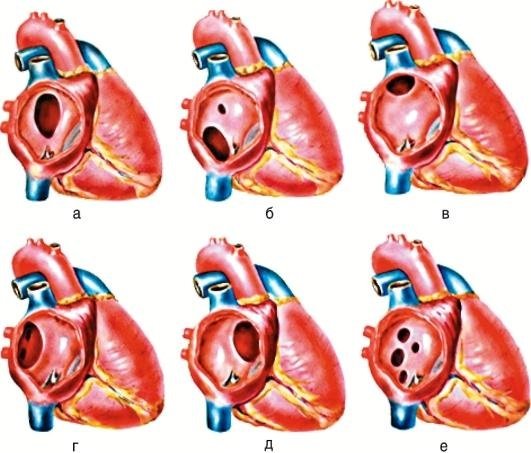 Варианты дефектов межпредсердной перегородки
