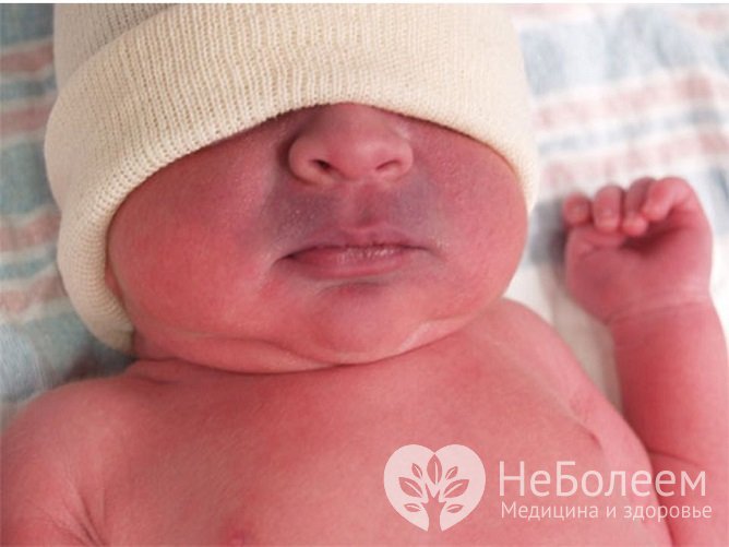 Цианоз носогубного треугольника у новорожденного – первый признак дефекта межпредсердной перегородки