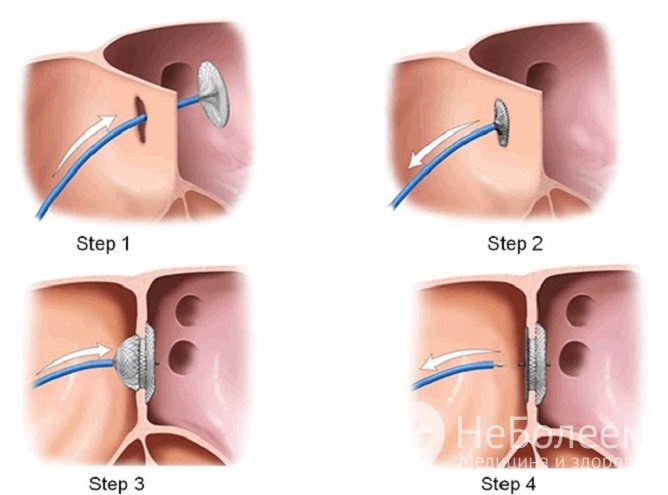 Эндоваскулярная методика закрытия дефекта межпредсердной перегородки