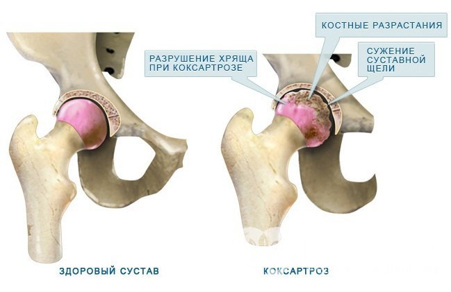 При деформирующем артрозе поражаются суставные хрящи и костные поверхности