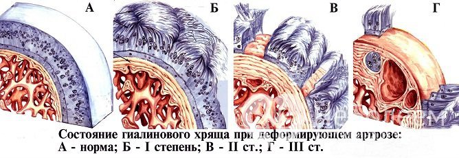 Стадии деформирующего артроза