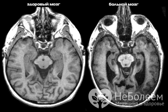 Диагностировать деменцию помогают КТ или МРТ