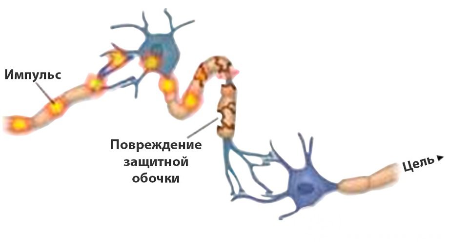 Разрушение миелиновой оболочки нервных волокон