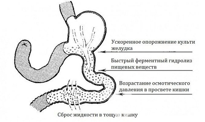 При демпинг-синдроме содержимое желудка, не обработанное должным образом, сбрасывается в тонкий кишечник