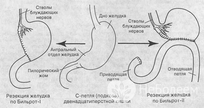 Наиболее часто демпинг-синдром развивается после резекции желудка