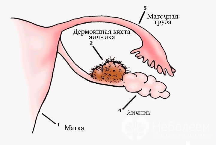 Признаки дермоидной кисты яичника