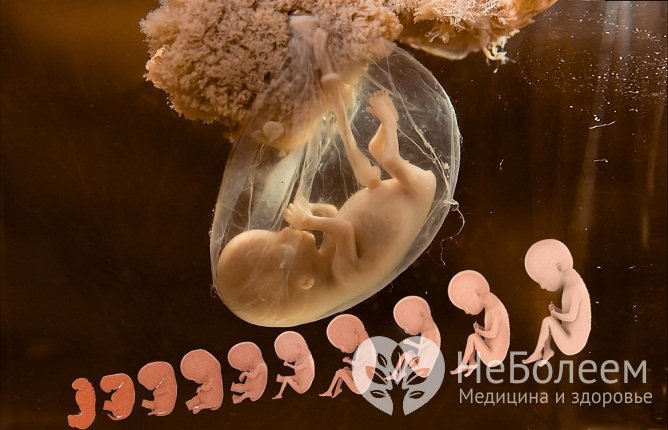 Основная причина появления дермоидной кисты яичника – нарушения дифференцировки тканей в ход эмбриогенеза