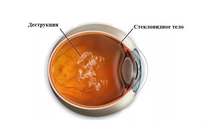 Признаки деструкции стекловидного тела