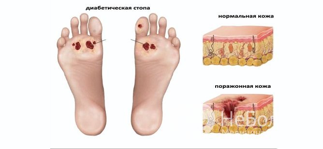 Диабетическая ангиопатия сосудов нижних конечностей