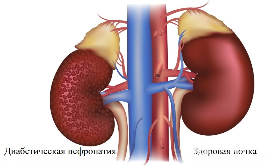 Признаки диабетической нефропатии
