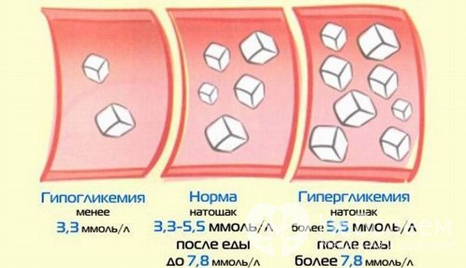 Развитию диабетической нефропатии в значительной мере способствует длительная гипергликемия