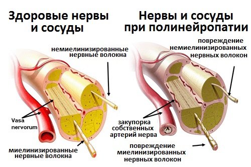 В основе диабетической нейропатии лежит поражение мельчайших кровеносных сосудов