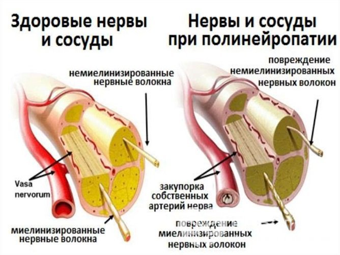 Нервы и сосуды при диабетической полинейропатии