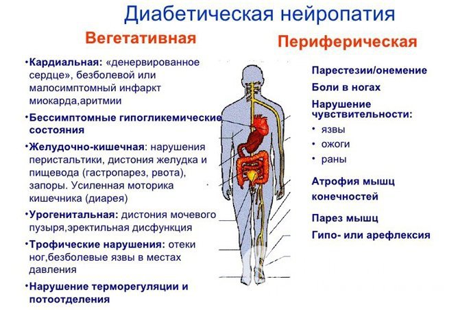 Симптомы диабетической полинейропатии