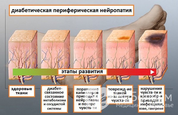 Возможные осложнения и последствия диабетической полинейропатии