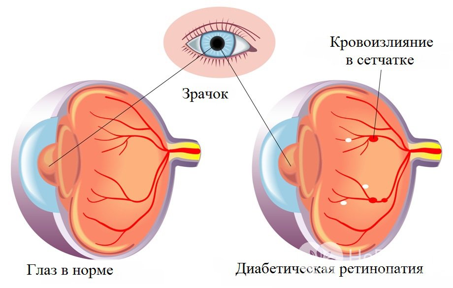 Признаки диабетической ретинопатии