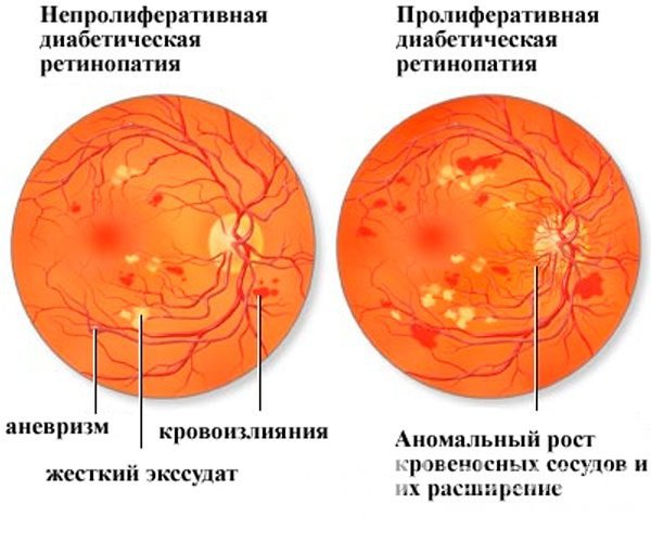 Формы диабетической нейропатии