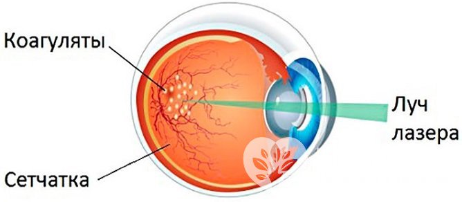 Лазерная коагуляция сетчатки глаза