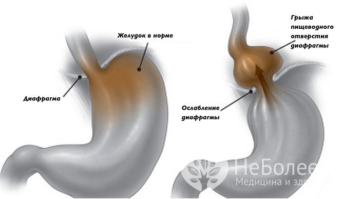 Диафрагмальная грыжа: симптомы и лечение