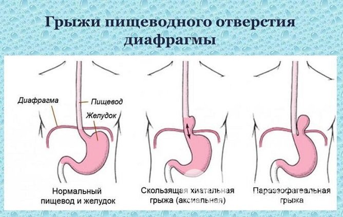 Формы диафрагмальной грыжи