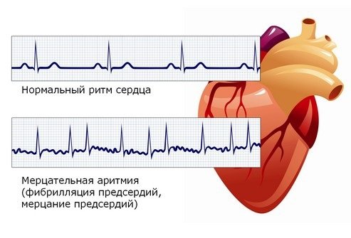 Мерцательная аритмия способна приводит к дилатации правого предсердия