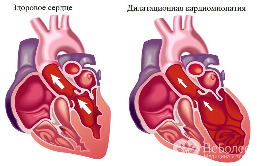 Признаки дилатационной кардиомиопатии 