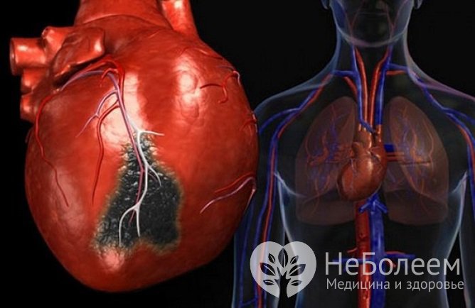 Инфекционное поражение миокарда может приводить к развитию дилатационной кардиомиопатии