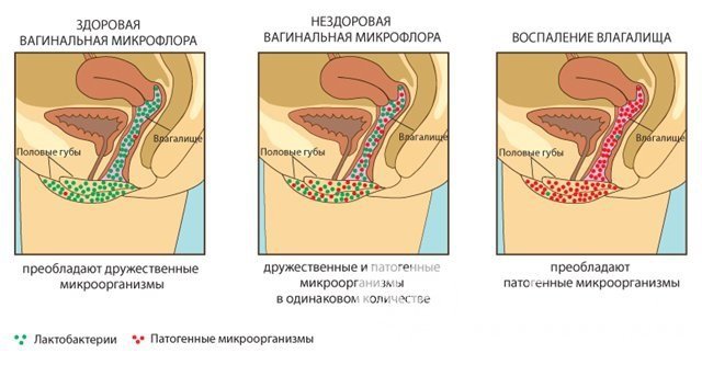 При дисбактериозе влагалища нарушается нормальный состав микрофлоры