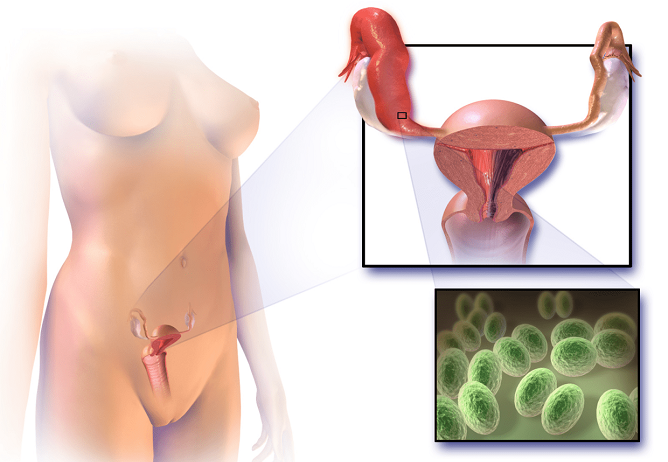 Наиболее распространенные причины дисбактериоза влагалища – ЗППП и инфекционно-воспалительные заболевания органов малого таза