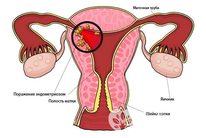 Эндометриоз – одна из причин дисфункции яичников