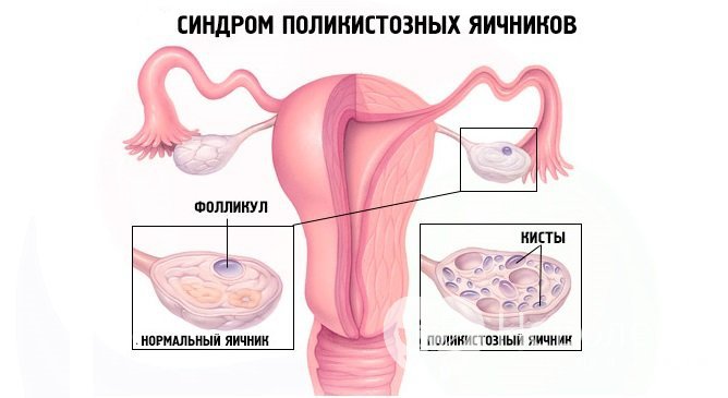 Синдром поликистозных яичников - одна из форм дисфункции яичников