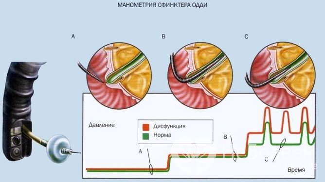 Эндоскопическая манометрия с целью диагностики дисфункции сфинктера Одди