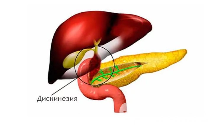 Признаки дискинезии желчевыводящих путей