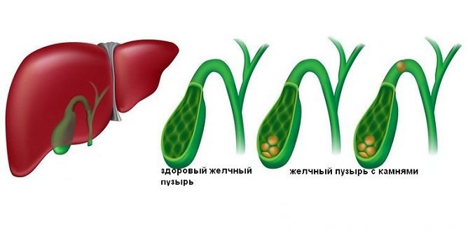 Калькулезный холецистит – возможное осложнение дискинезии желчного пузыря