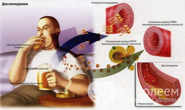 Причины дислипидемии