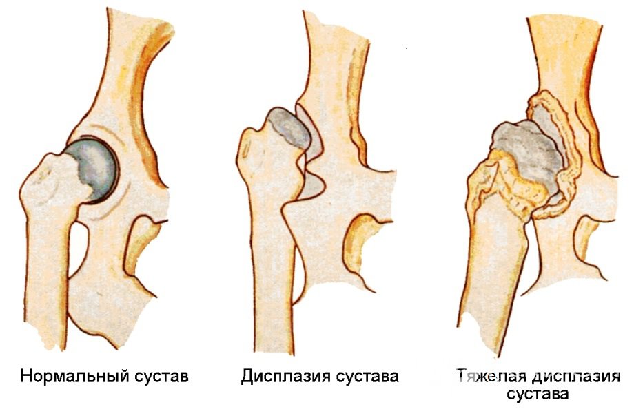 Симптомы дисплазии тазобедренного сустава