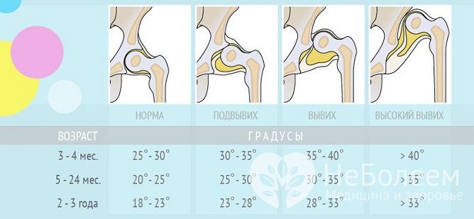 Нормы ацетабулярных углов у детей