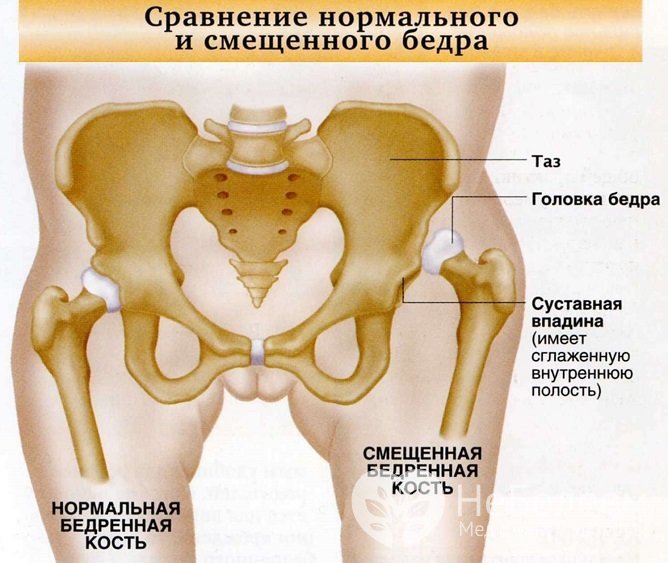 Дисплазия тазобедренного сустава