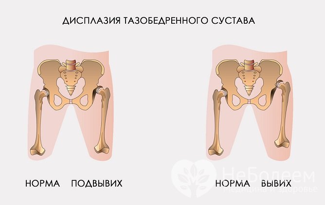 Степени дисплазии тазобедренных суставов