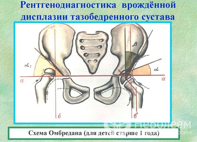 Диагностика дисплазии тазобедренных суставов