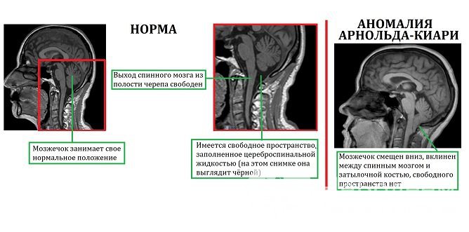 Дистопия миндалин мозжечка