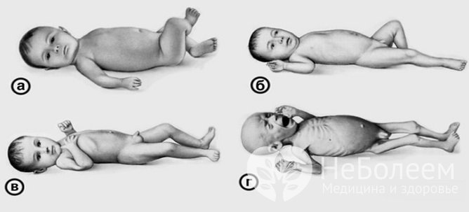 Признаки дистрофии у детей