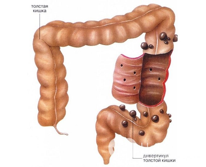 Дивертикулез кишечника: симптомы и лечение