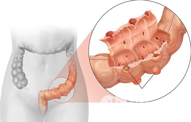 Дивертикулез сигмовидной кишки: симптомы и лечение