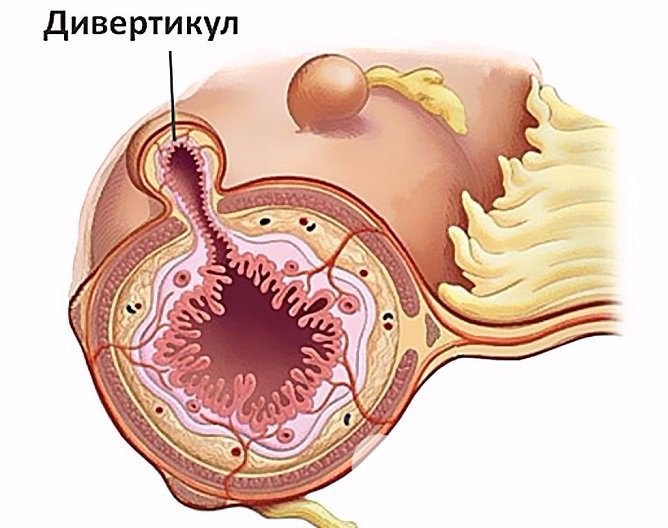 Признаки дивертикулеза сигмовидной кишки 