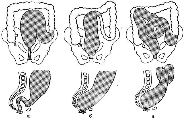 А — болезнь Гиршпрунга, б — идиопатический мегаколон, в — долихоколон